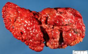 cirrhosis_of_the_liver[1]